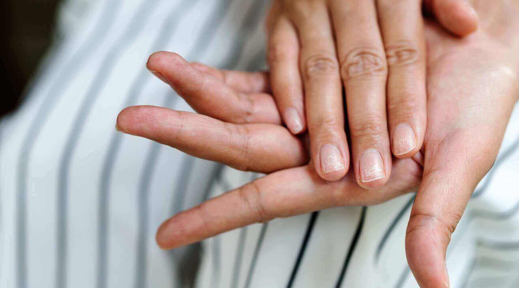 Behandlung von Nagelproblemen: gesunde Hände mit gepflegten Nägeln, die in einem persönlichen Pflegekontext gezeigt werden.